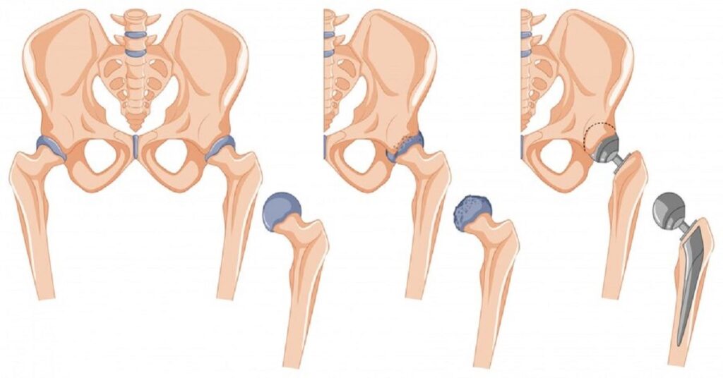 fracture neck of femur treatment in indore,fracture neck of femur treatment in indore, best fracture neck of femur treatment in indore,