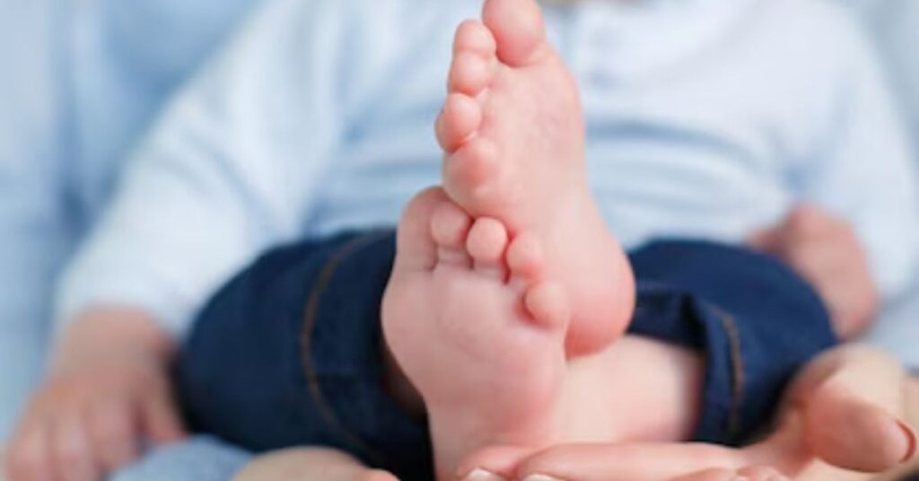 clubfoot treatment